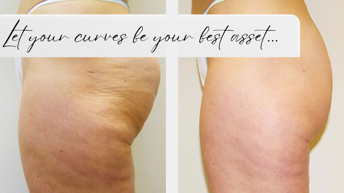 Carriel  VELASHAPE III: Cellulite Treatment